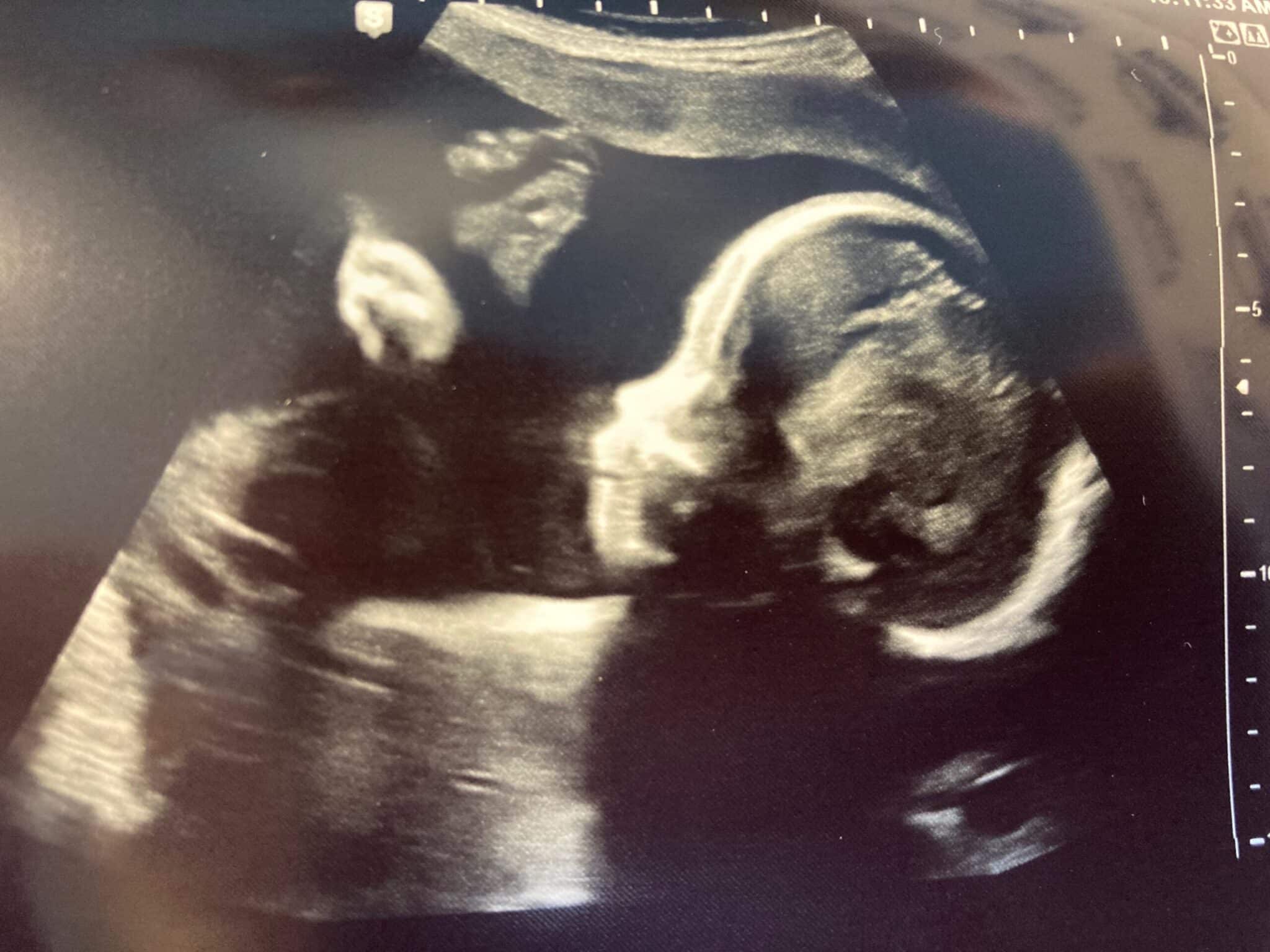 Ultrasound Image of Bosco Cooper